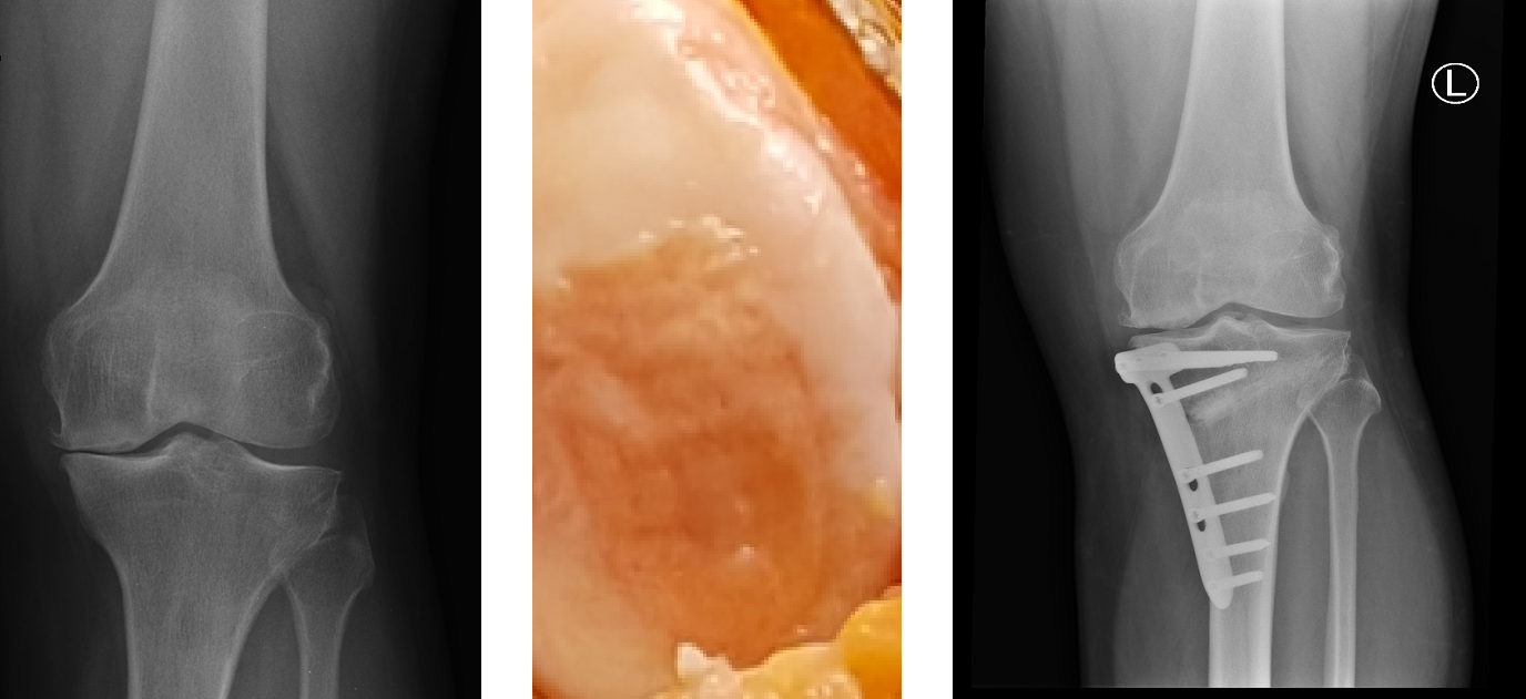 Biological joint replacement - The Cartilage Clinic