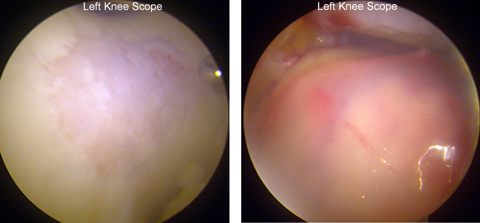 Left knee scope - The Cartilage Clinic