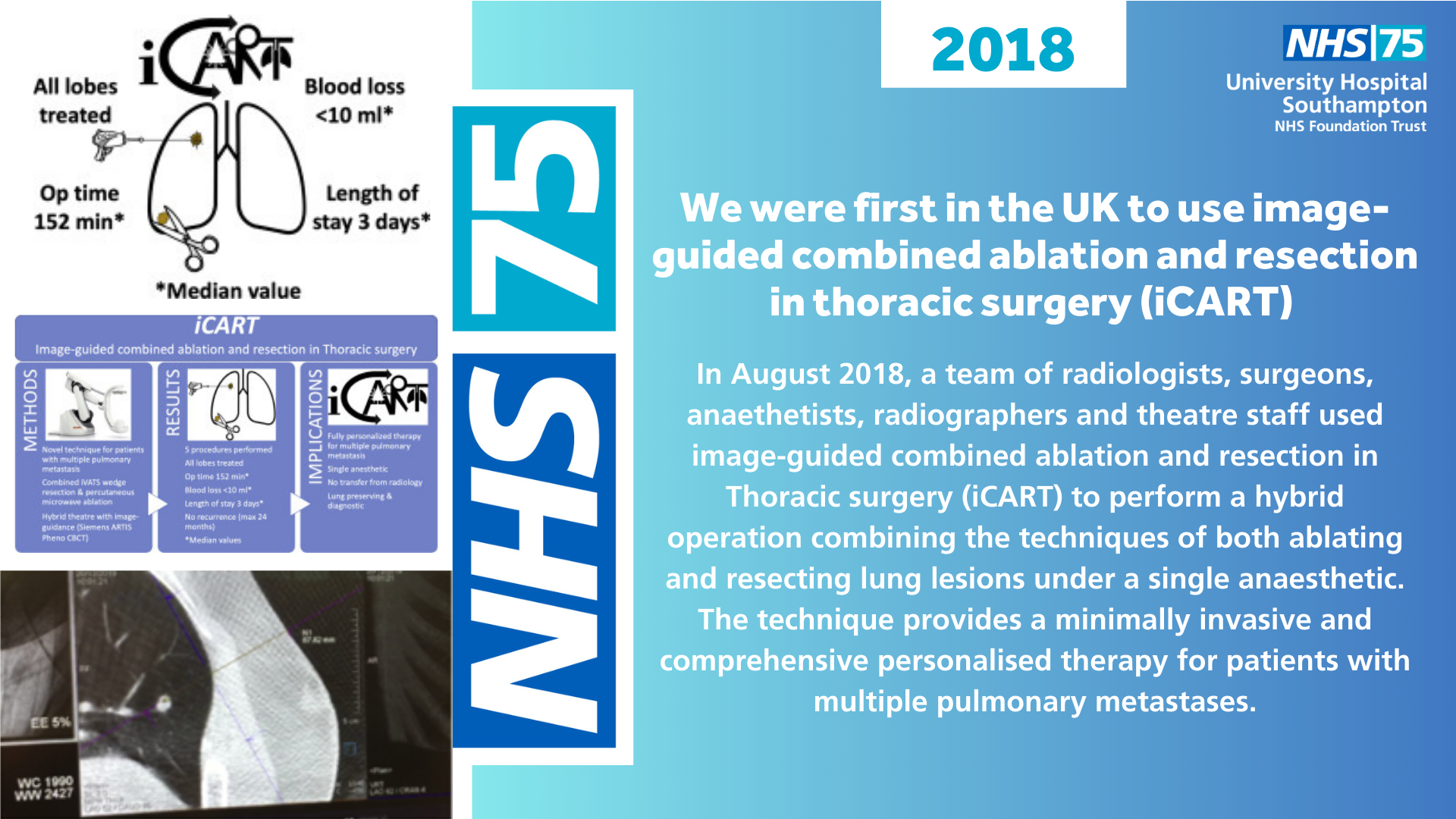 We were first in the UK to use image-guided combined ablation and resection in thoracic surgery (iCART)