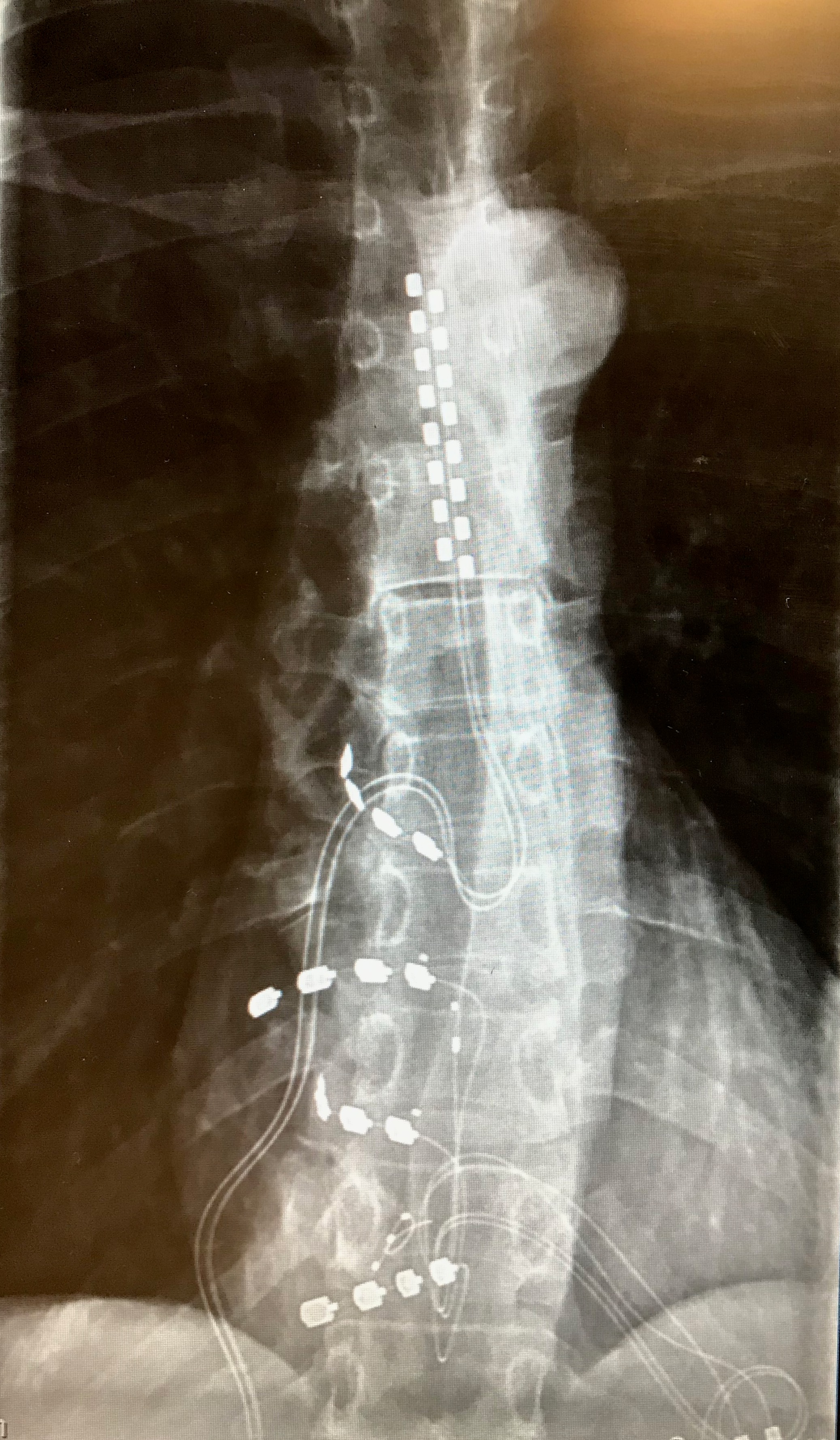Mrs Cameron's x-ray with implants around her spine