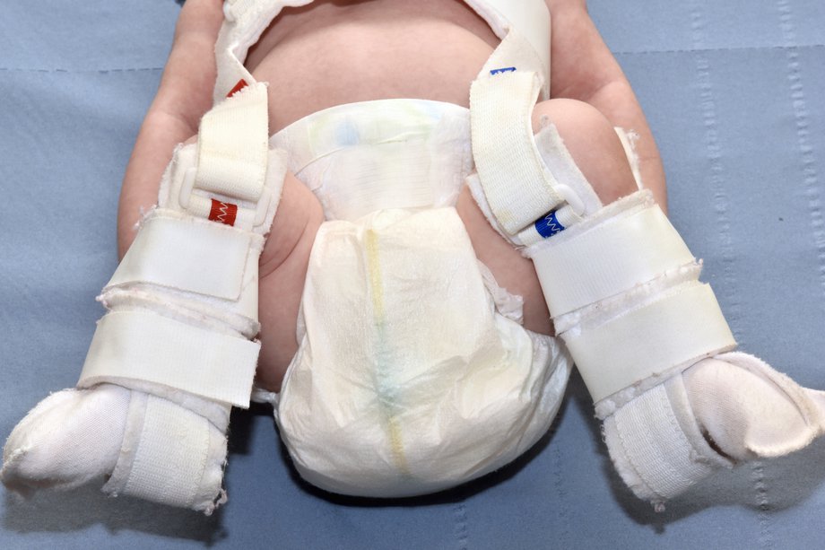 Baby wearing the Pavlik harness (image courtesy of NHS website)