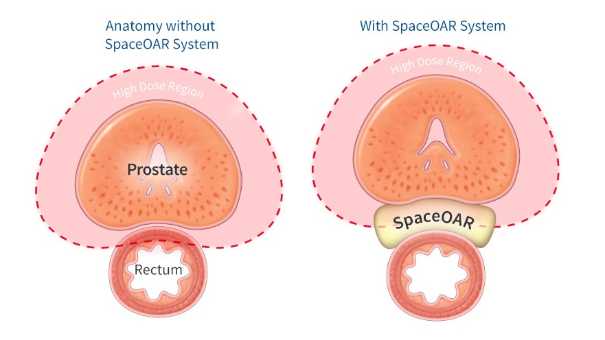 Illustration of SpaceOAR in situ