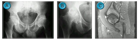 Hip X-ray